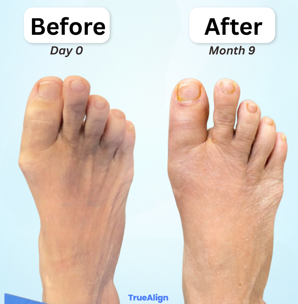 TrueAlign™ Bunion Corrector