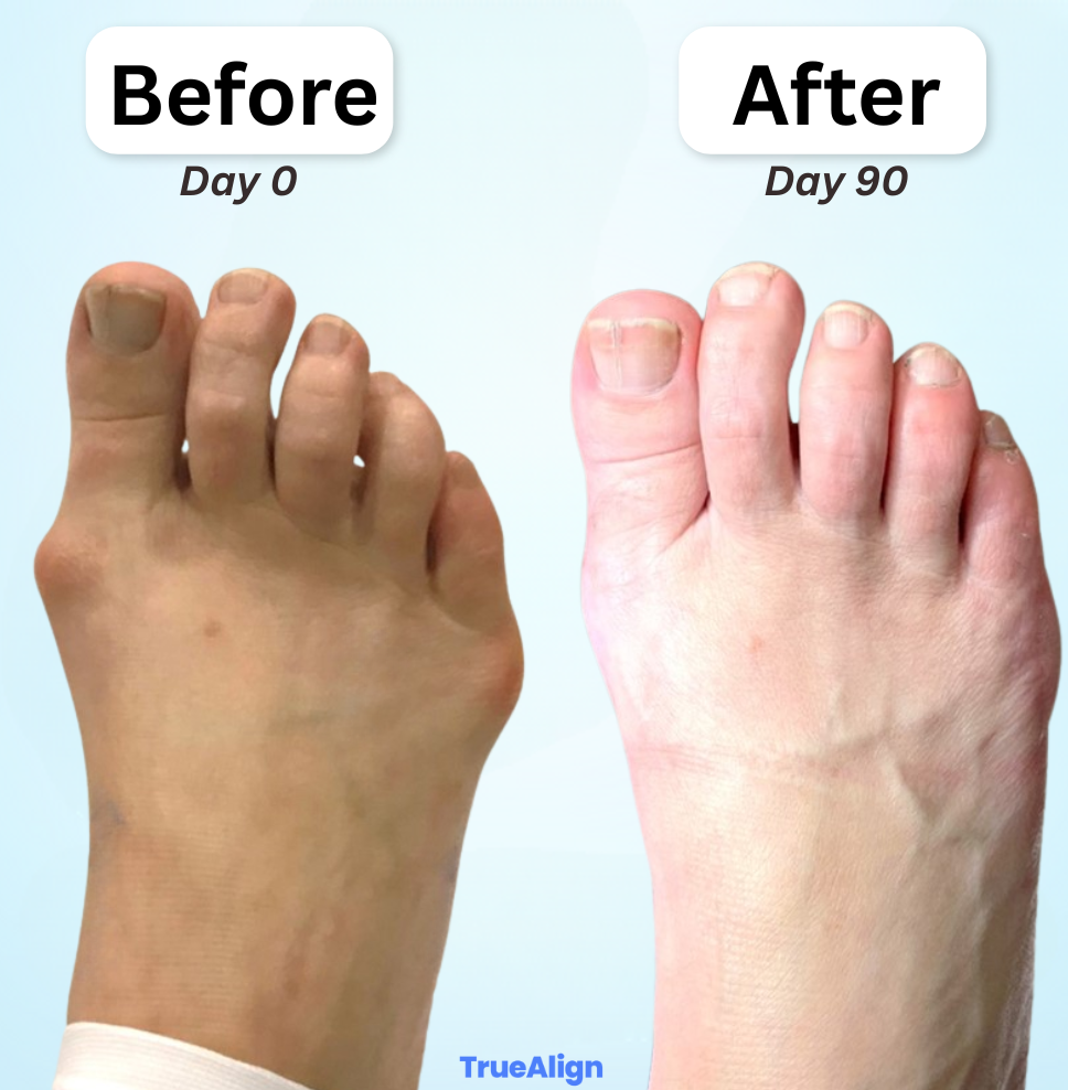 TrueAlign™ Bunion Corrector